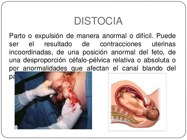 distocias de origen fetal
